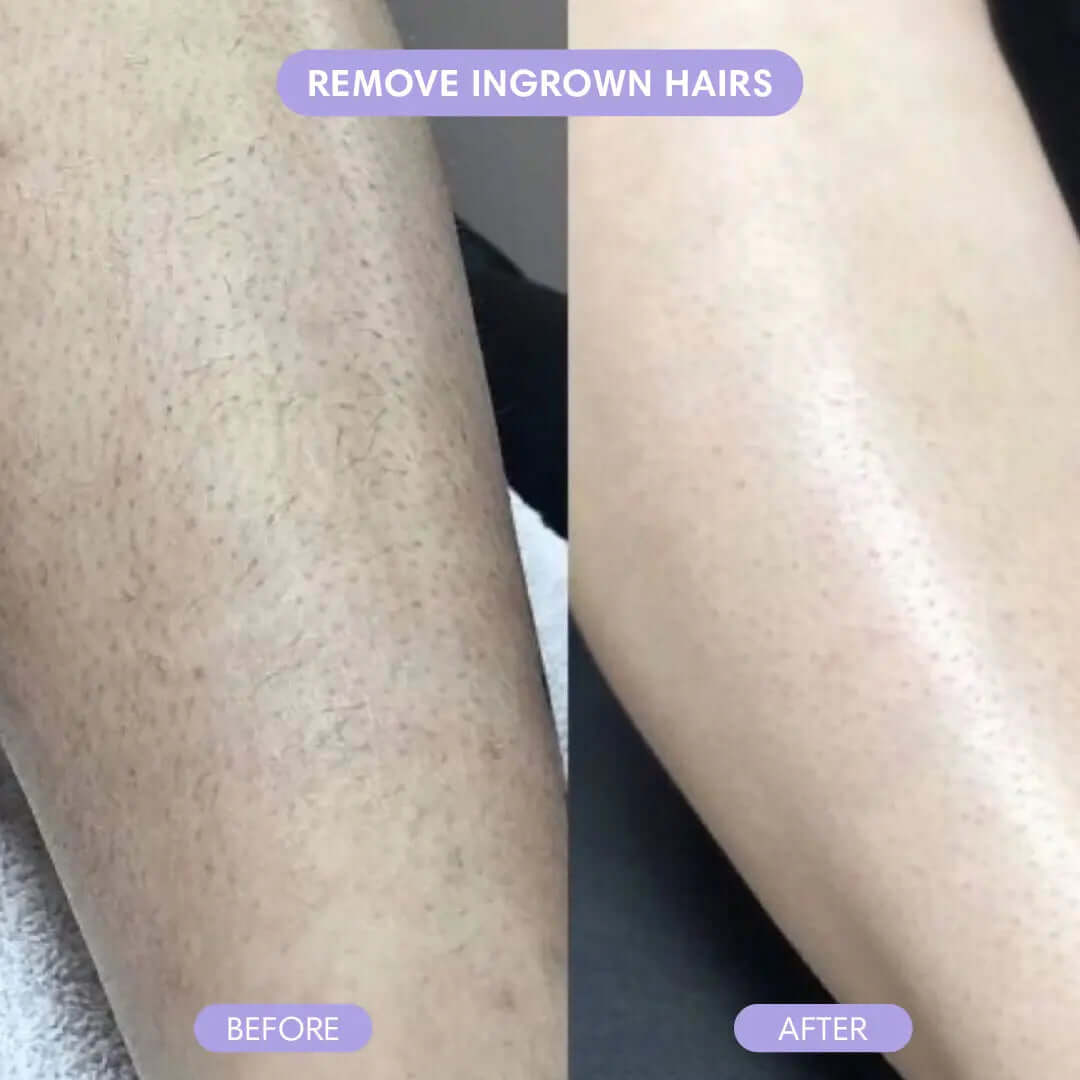Before and after comparison showing smooth skin with pain-free hair removal tool removing ingrown hairs