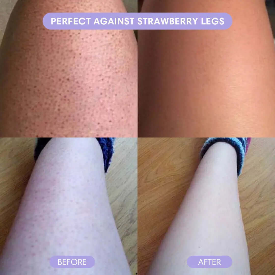 Before and after comparison showing smooth legs using pain-free hair removal tool for strawberry legs