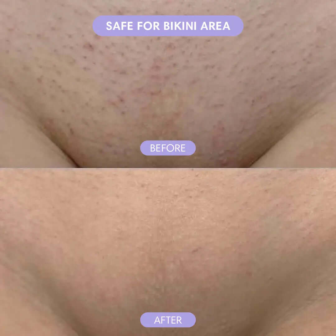 Before and after close-up showing smooth skin using the pain-free hair removal tool safe for bikini area